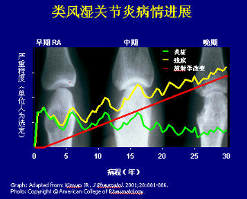 推荐阅读类风湿的治疗.jpg